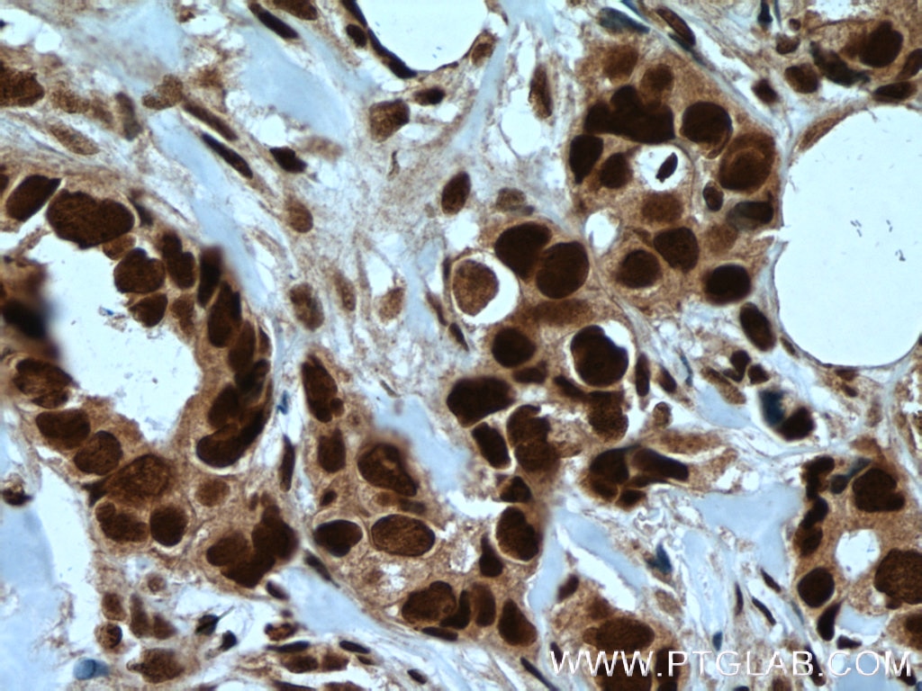 Immunohistochemistry (IHC) staining of human breast cancer tissue using RAD21 Polyclonal antibody (27071-1-AP)
