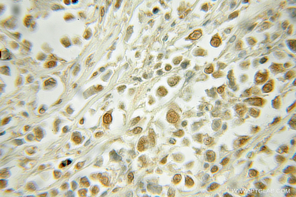 Immunohistochemistry (IHC) staining of human lymphoma tissue using RAD23A Polyclonal antibody (51033-1-AP)