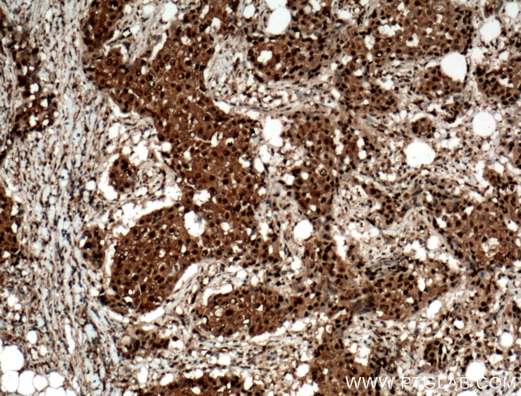 Immunohistochemistry (IHC) staining of human breast cancer tissue using RAD23B Polyclonal antibody (12121-1-AP)