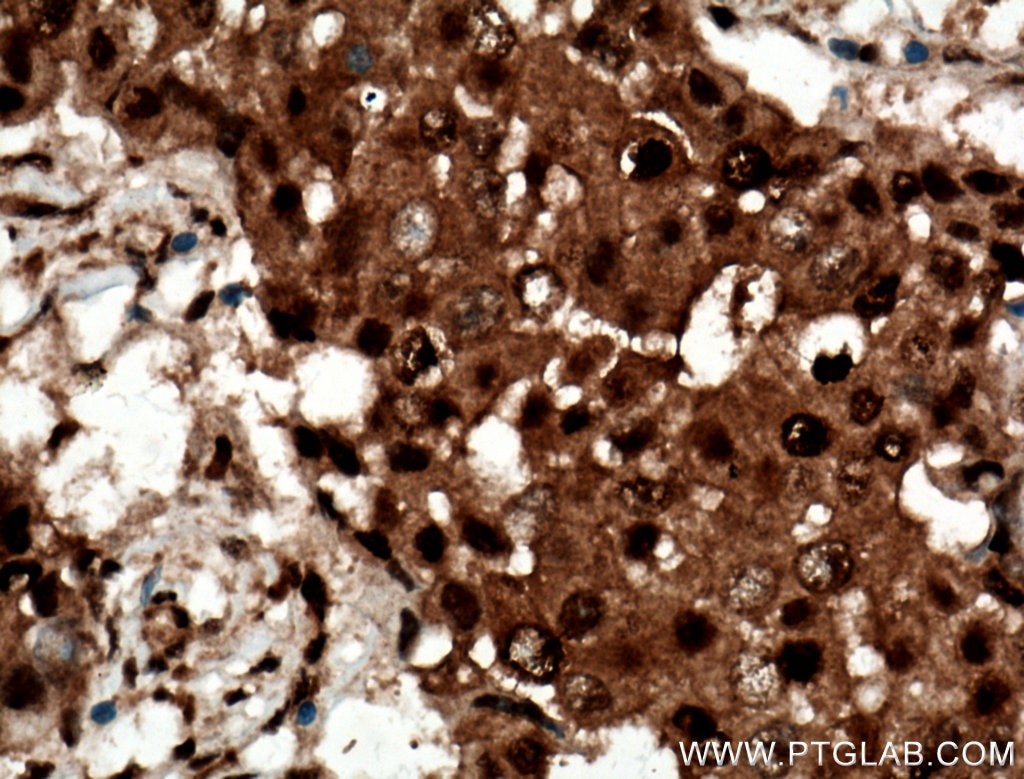 Immunohistochemistry (IHC) staining of human breast cancer tissue using RAD23B Polyclonal antibody (12121-1-AP)