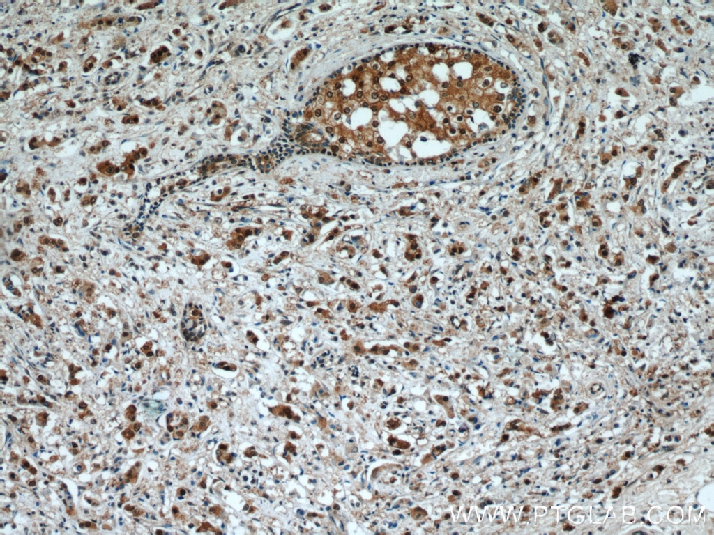 Immunohistochemistry (IHC) staining of human breast cancer tissue using RAD23B Polyclonal antibody (12121-1-AP)