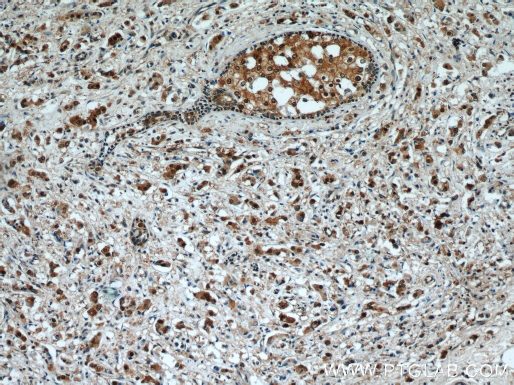 IHC staining of human breast cancer using 12121-1-AP