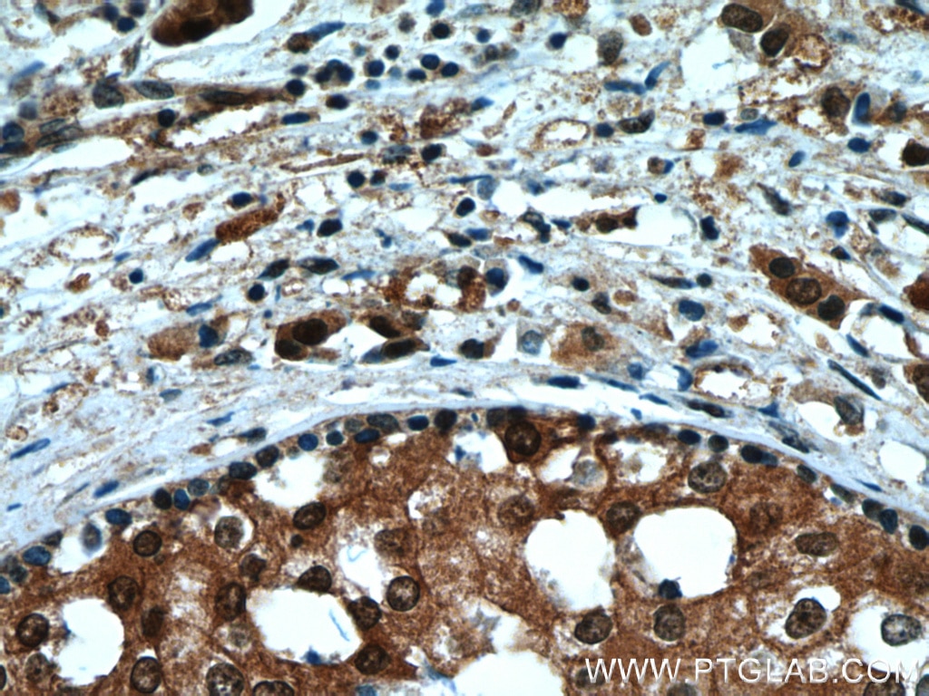 Immunohistochemistry (IHC) staining of human breast cancer tissue using RAD23B Polyclonal antibody (12121-1-AP)