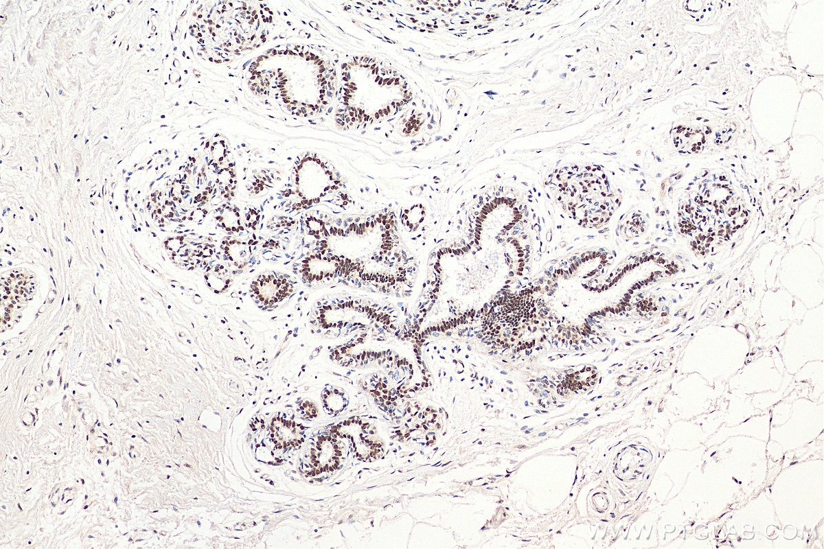IHC staining of human breast cancer using 29390-1-AP