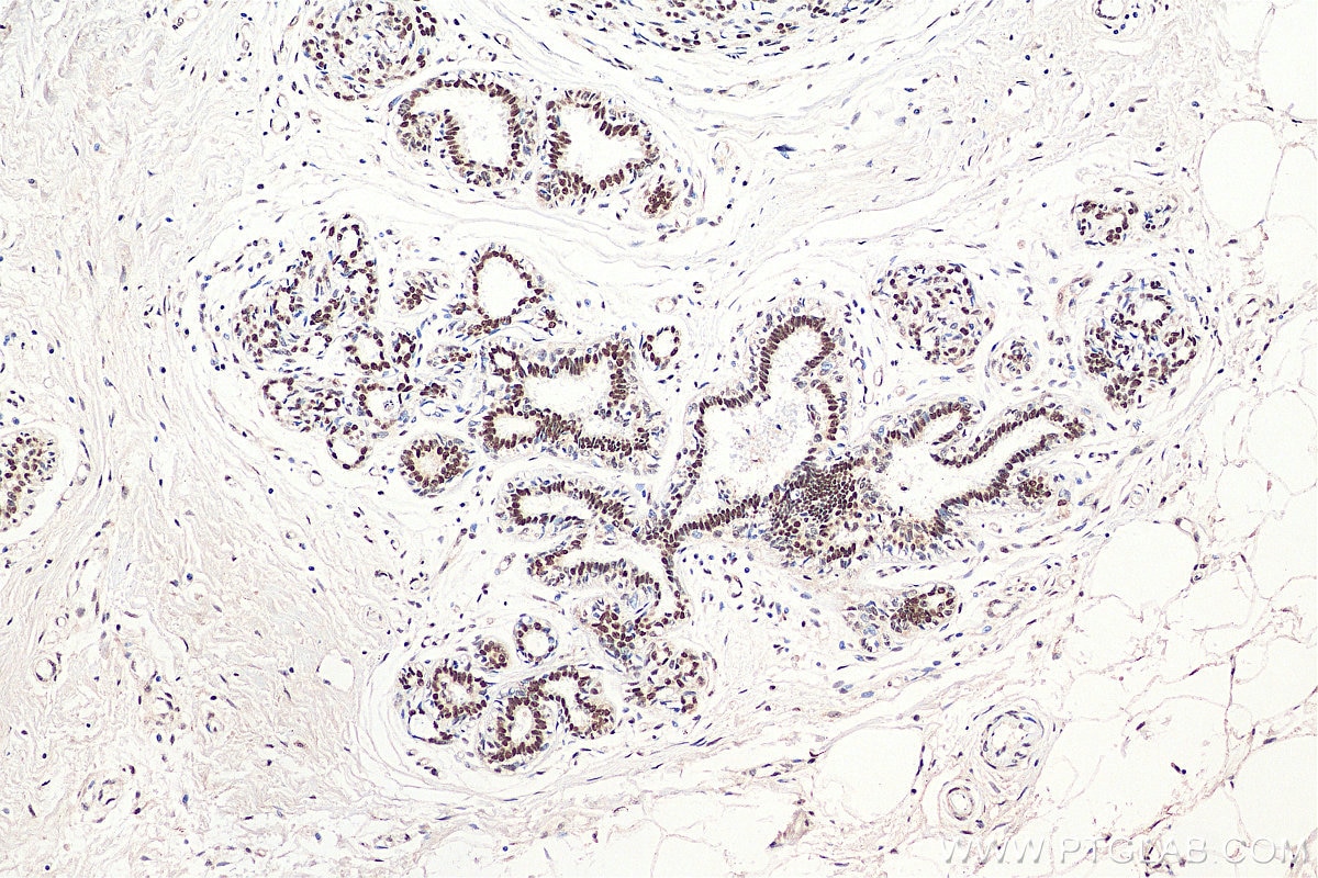 Immunohistochemistry (IHC) staining of human breast cancer tissue using RAD50 Polyclonal antibody (29390-1-AP)