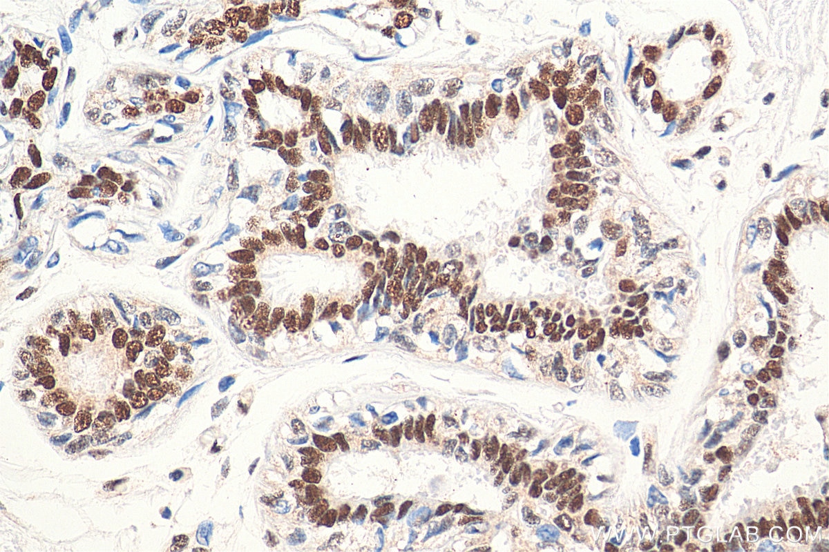 Immunohistochemistry (IHC) staining of human breast cancer tissue using RAD50 Polyclonal antibody (29390-1-AP)