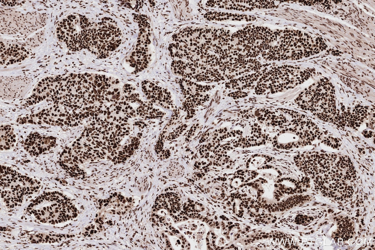 Immunohistochemistry (IHC) staining of human stomach cancer tissue using RAD50 Recombinant antibody (84969-4-RR)
