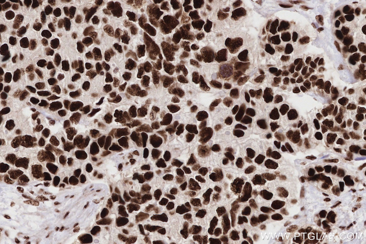 Immunohistochemistry (IHC) staining of human stomach cancer tissue using RAD50 Recombinant antibody (84969-4-RR)