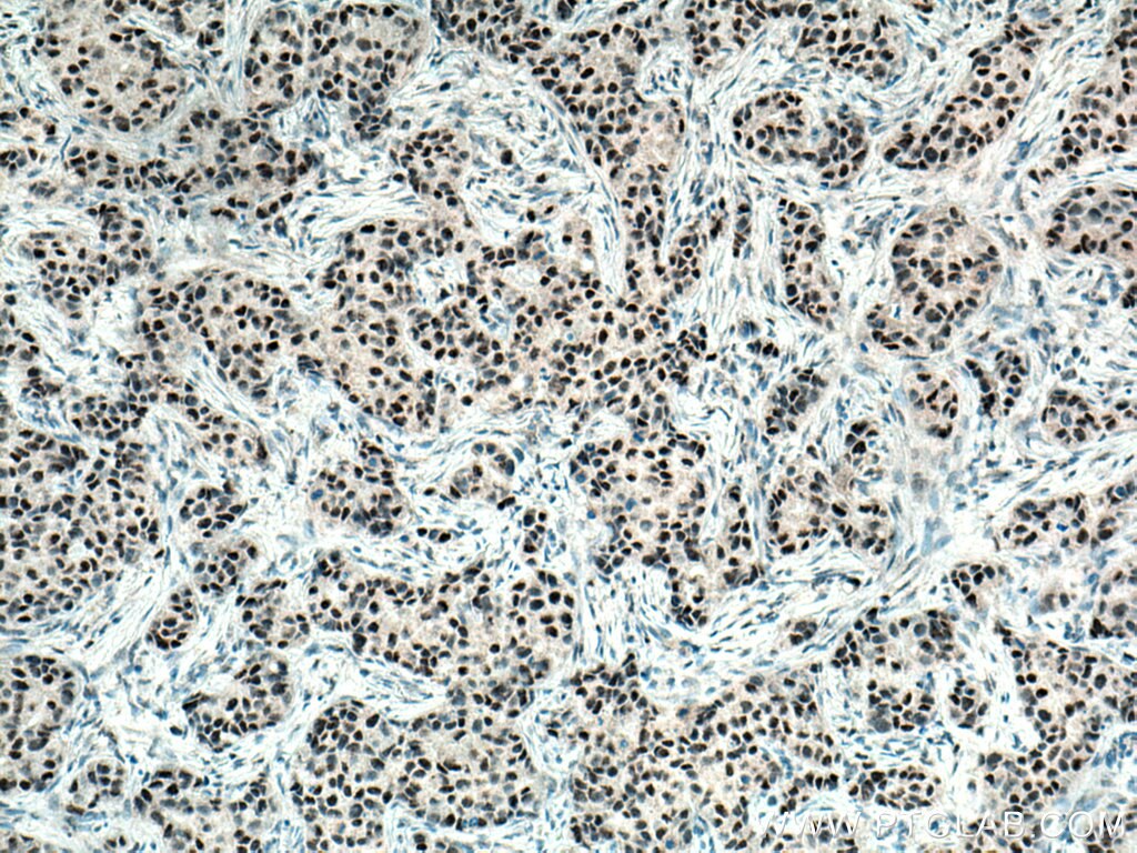 Immunohistochemistry (IHC) staining of human breast cancer tissue using RAD9A Polyclonal antibody (13035-1-AP)