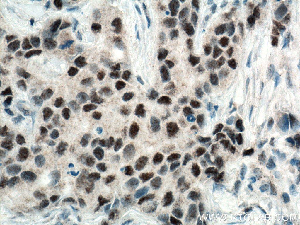Immunohistochemistry (IHC) staining of human breast cancer tissue using RAD9A Polyclonal antibody (13035-1-AP)