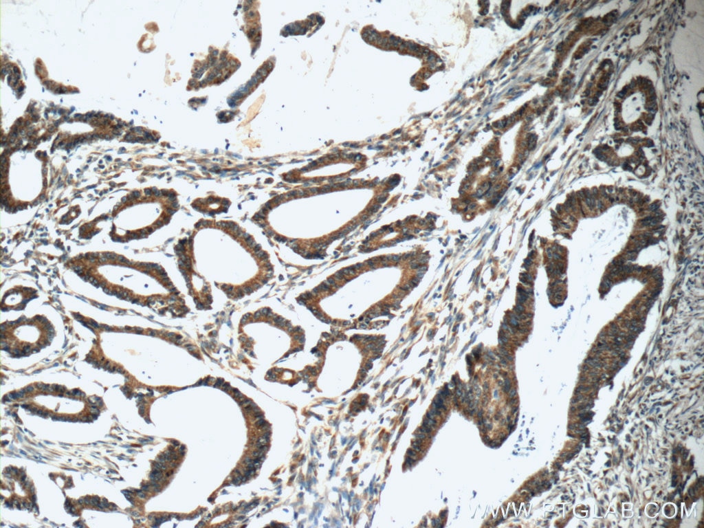 Immunohistochemistry (IHC) staining of human colon cancer tissue using RAF1 Polyclonal antibody (12388-1-AP)
