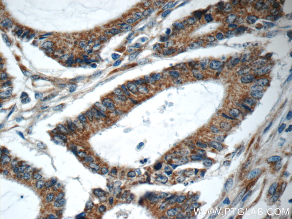 Immunohistochemistry (IHC) staining of human colon cancer tissue using RAF1 Polyclonal antibody (12388-1-AP)