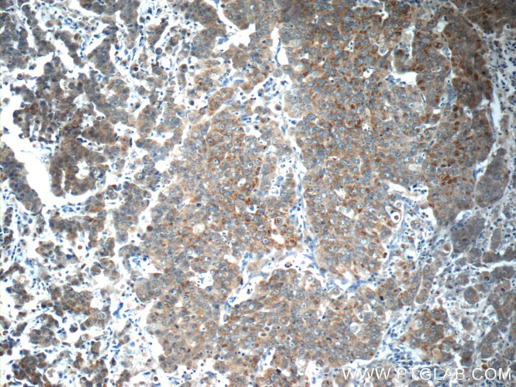 Immunohistochemistry (IHC) staining of human prostate cancer tissue using RAF1 Polyclonal antibody (12388-1-AP)