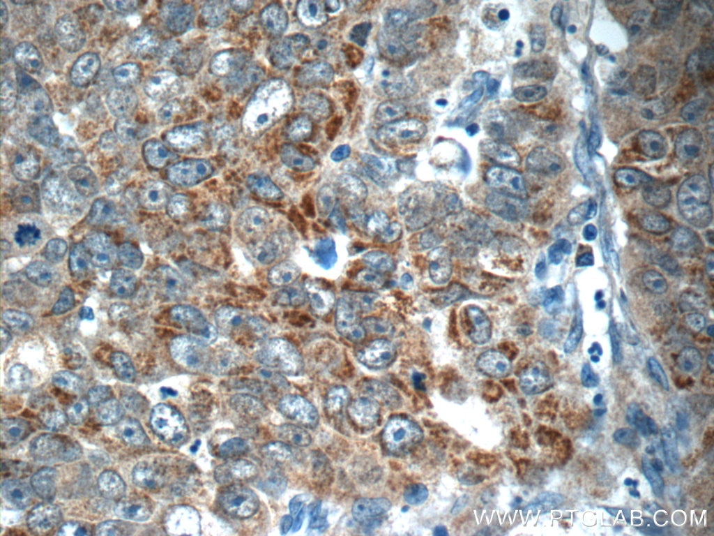 Immunohistochemistry (IHC) staining of human prostate cancer tissue using RAF1 Polyclonal antibody (12388-1-AP)