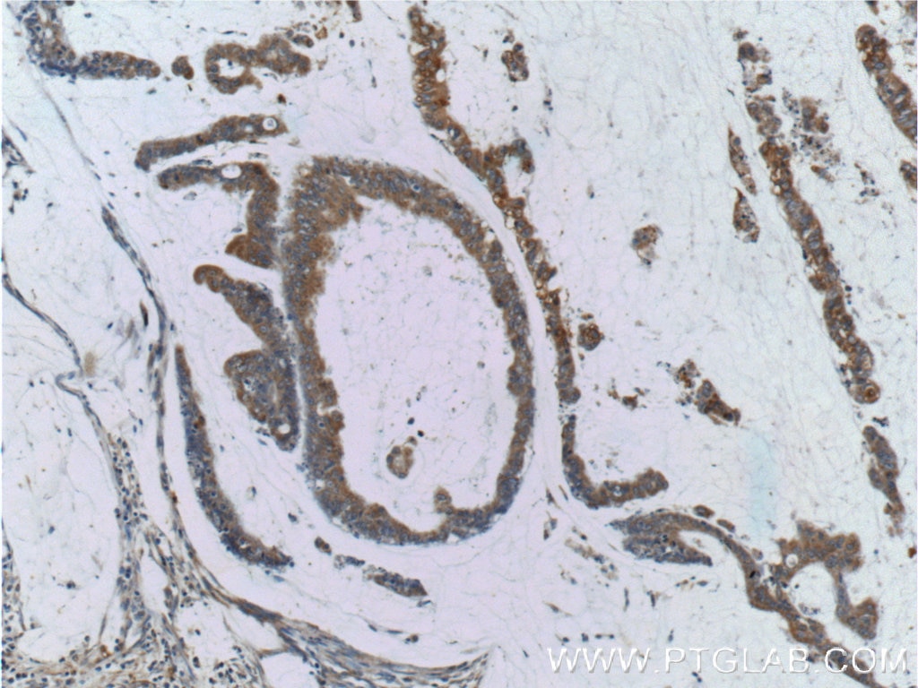 Immunohistochemistry (IHC) staining of human colon cancer tissue using RAF1 Polyclonal antibody (12388-1-AP)