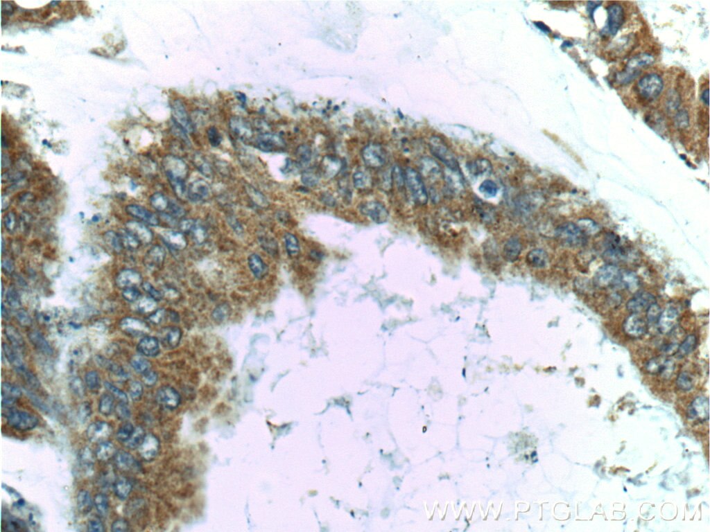 Immunohistochemistry (IHC) staining of human colon cancer tissue using RAF1 Polyclonal antibody (12388-1-AP)