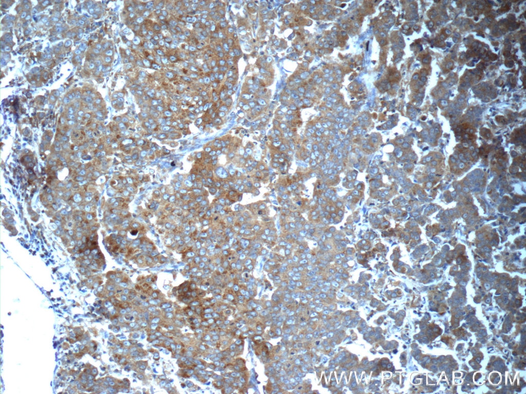 Immunohistochemistry (IHC) staining of human prostate cancer tissue using RAF1 Polyclonal antibody (12388-1-AP)