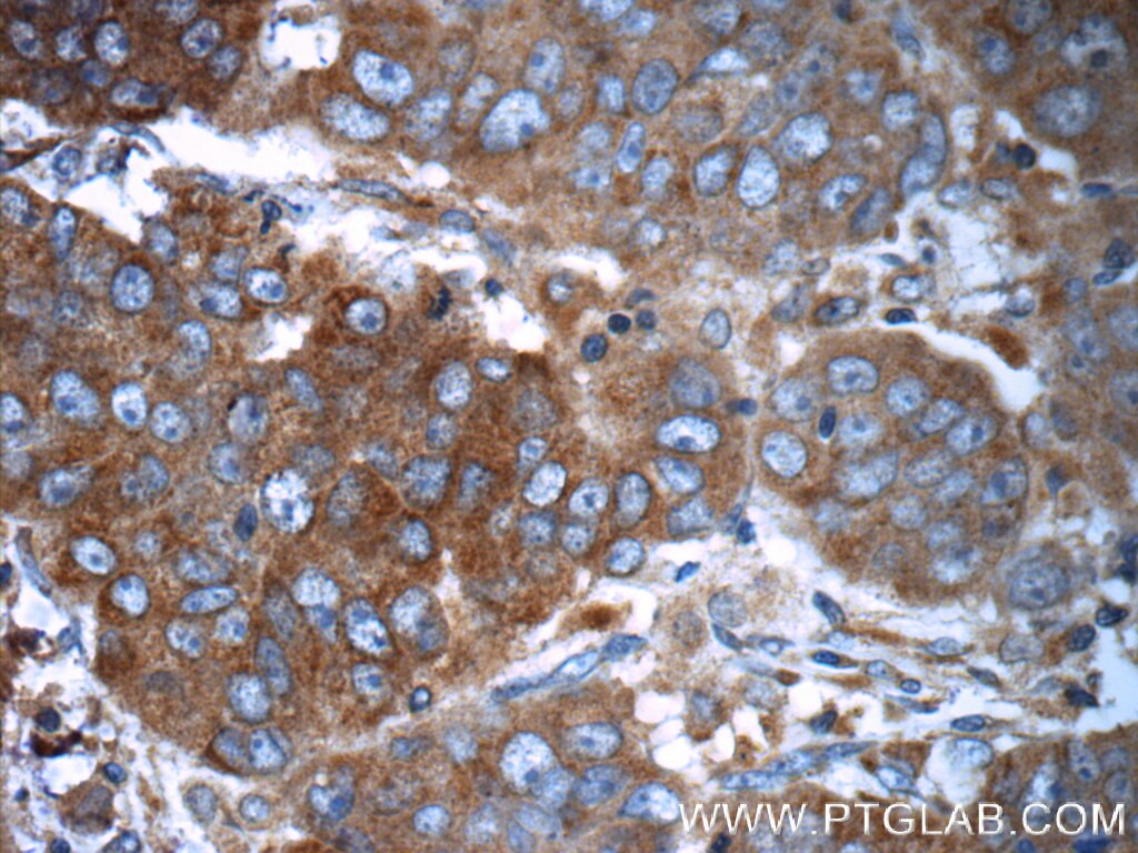 Immunohistochemistry (IHC) staining of human prostate cancer tissue using RAF1 Polyclonal antibody (12388-1-AP)