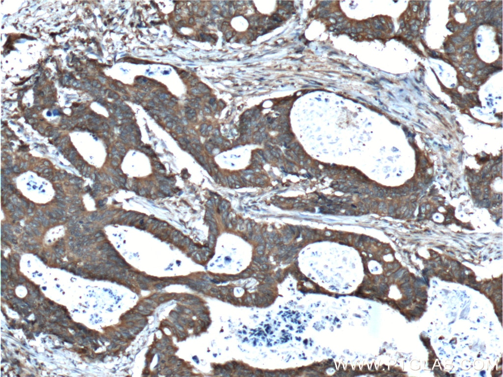 Immunohistochemistry (IHC) staining of human colon cancer tissue using RAF1 Polyclonal antibody (26863-1-AP)
