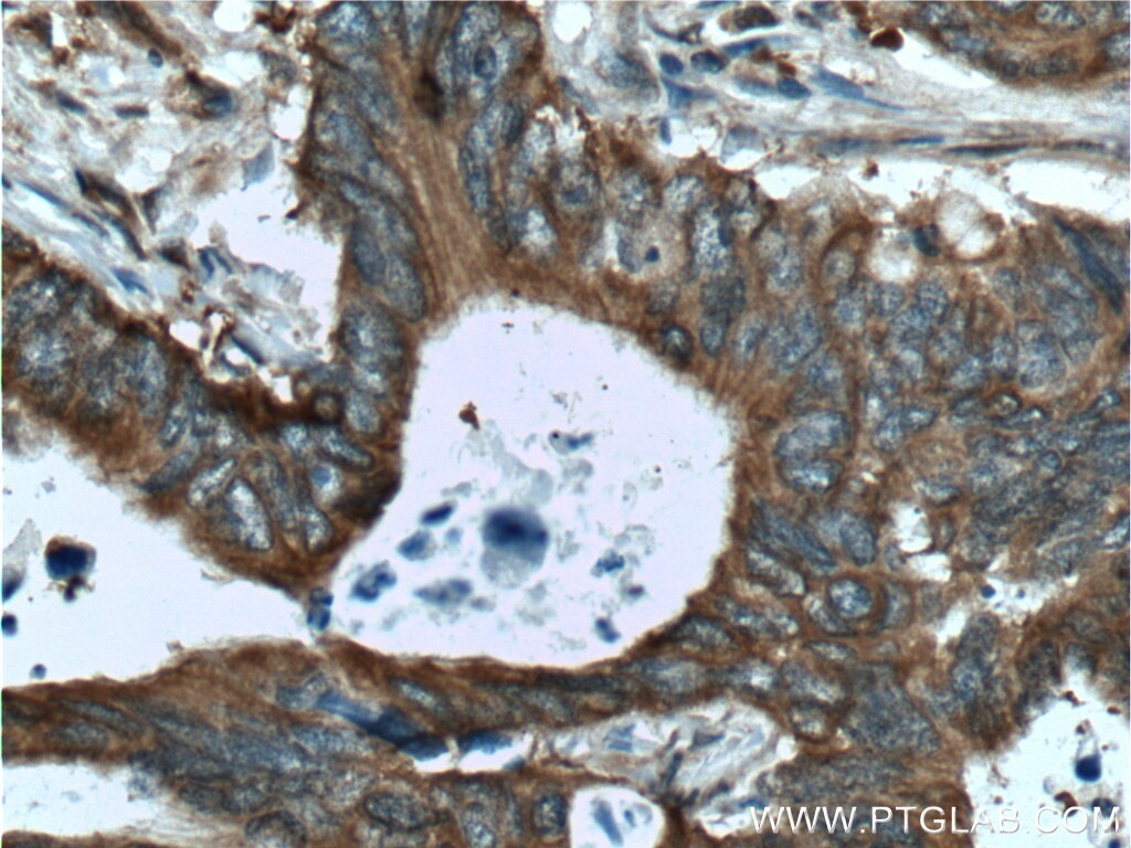 IHC staining of human colon cancer using 26863-1-AP