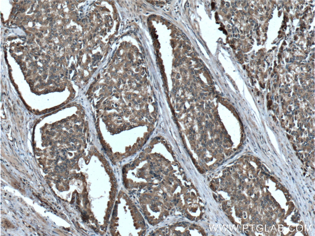 Immunohistochemistry (IHC) staining of human prostate cancer tissue using RAF1 Polyclonal antibody (26863-1-AP)