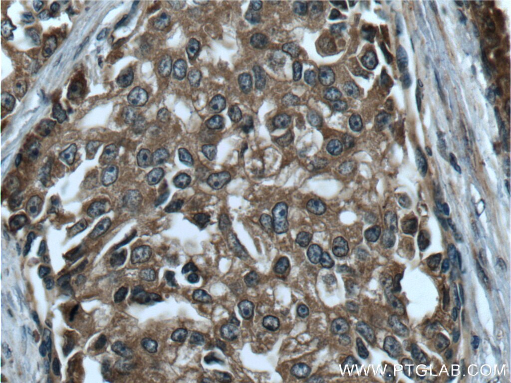 Immunohistochemistry (IHC) staining of human prostate cancer tissue using RAF1 Polyclonal antibody (26863-1-AP)