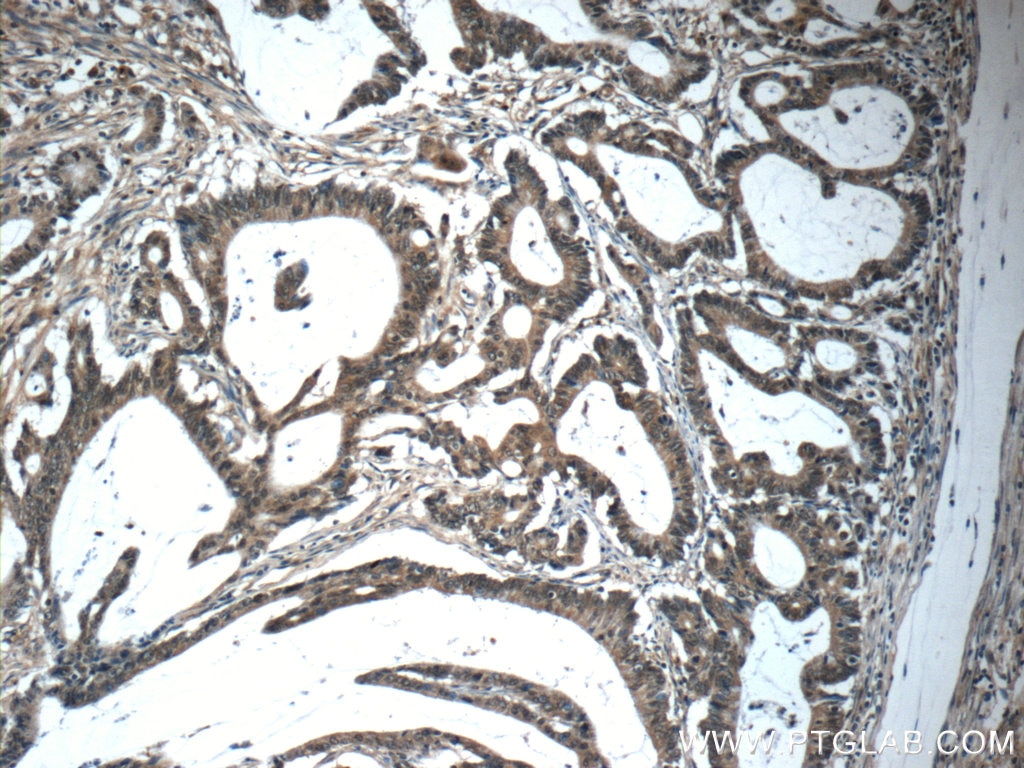 Immunohistochemistry (IHC) staining of human colon cancer tissue using RAF1 Polyclonal antibody (51140-1-AP)