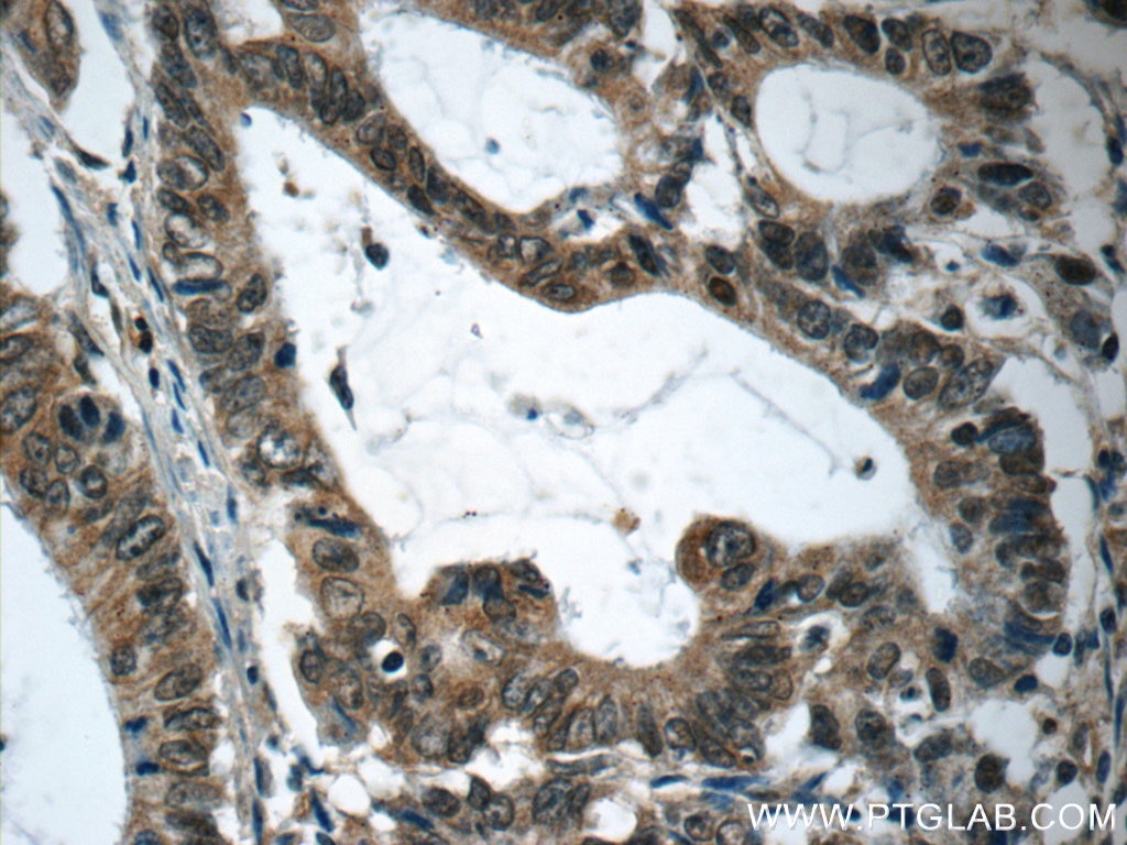 Immunohistochemistry (IHC) staining of human colon cancer tissue using RAF1 Polyclonal antibody (51140-1-AP)
