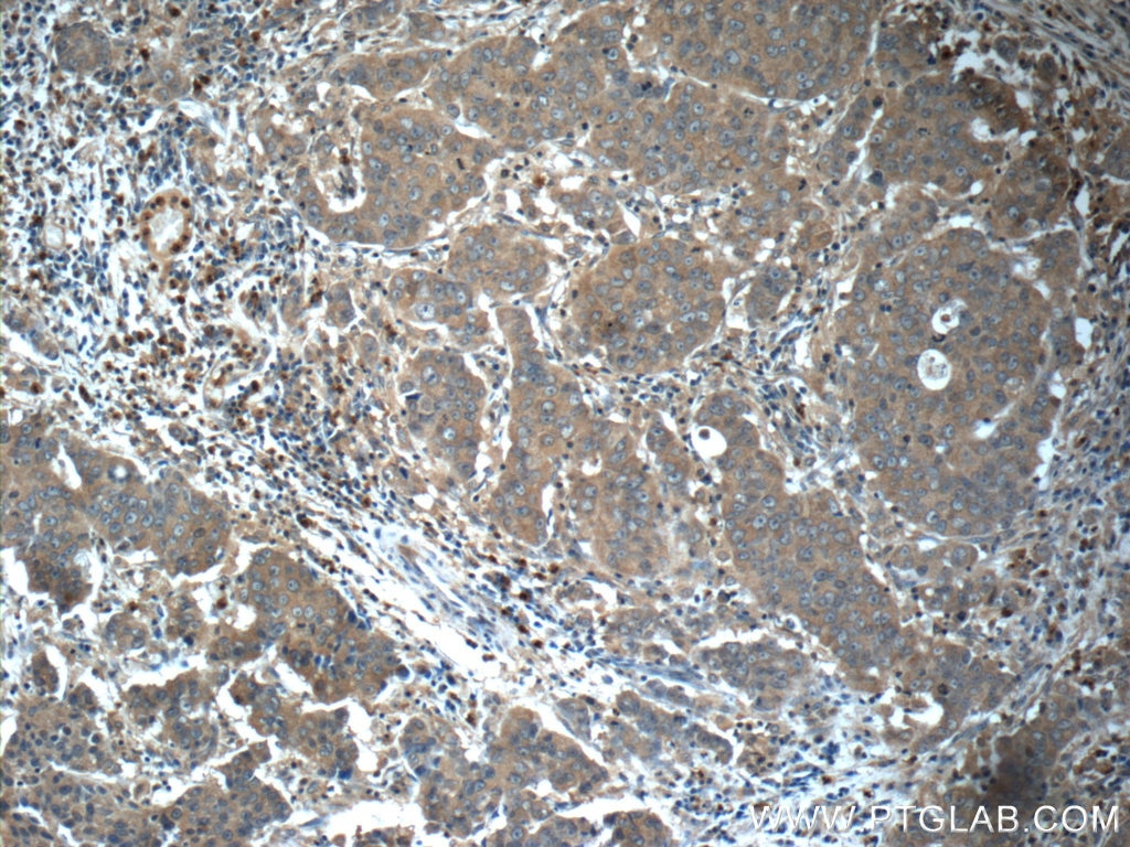 Immunohistochemistry (IHC) staining of human prostate cancer tissue using RAF1 Polyclonal antibody (51140-1-AP)