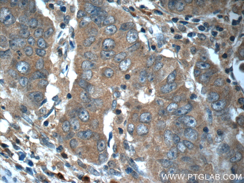 Immunohistochemistry (IHC) staining of human prostate cancer tissue using RAF1 Polyclonal antibody (51140-1-AP)