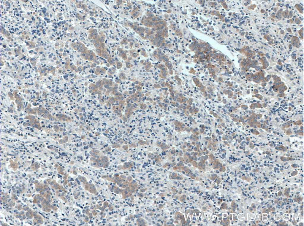Immunohistochemistry (IHC) staining of human prostate cancer tissue using RAF1 Monoclonal antibody (66592-1-Ig)