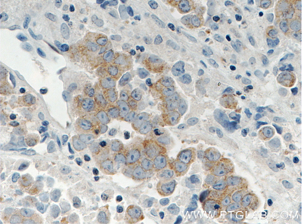 Immunohistochemistry (IHC) staining of human prostate cancer tissue using RAF1 Monoclonal antibody (66592-1-Ig)