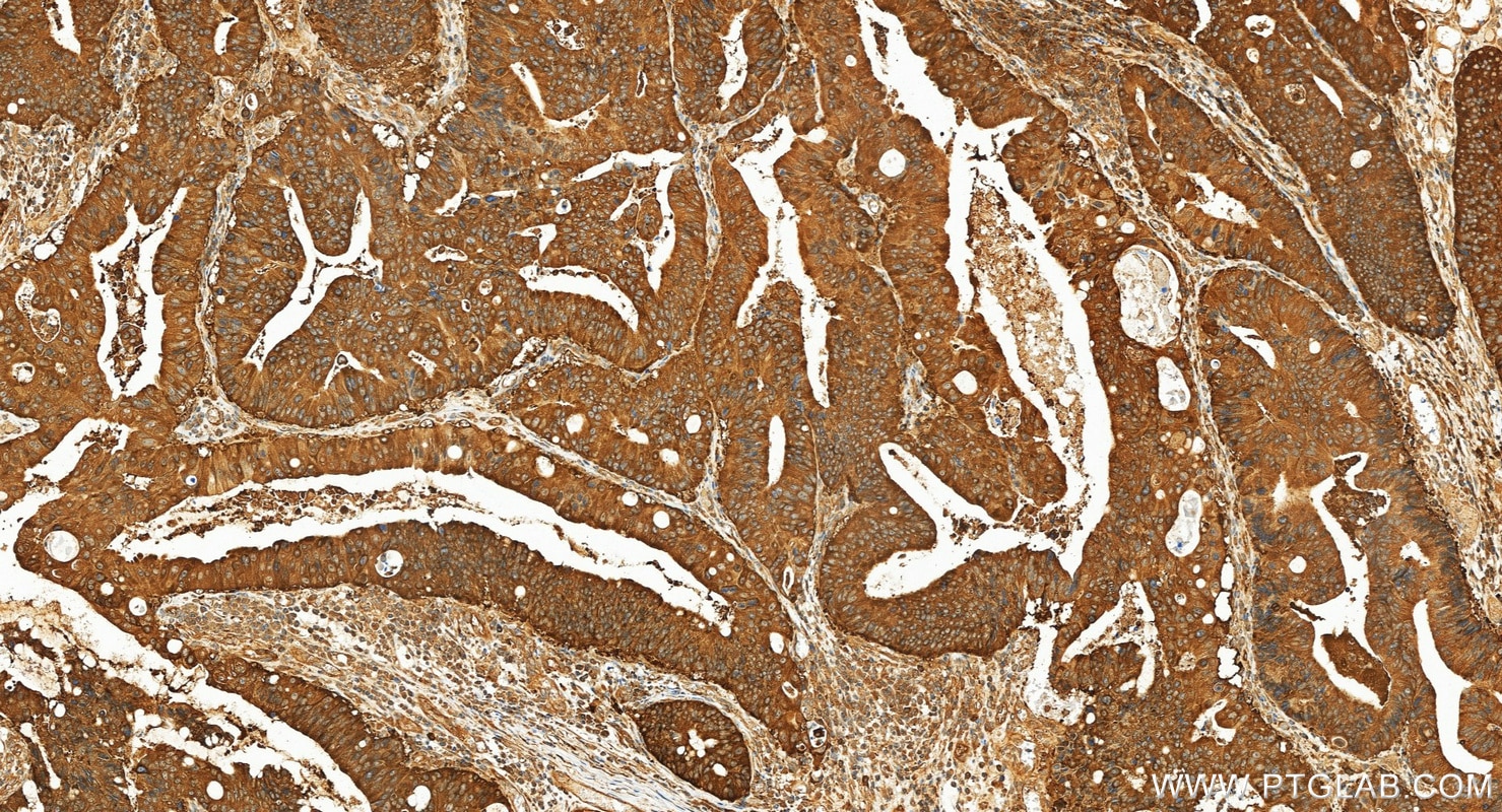 Immunohistochemistry (IHC) staining of human colon cancer tissue using RAF1 Recombinant monoclonal antibody (84994-4-RR)