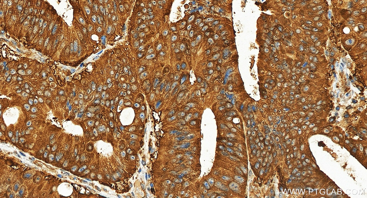 Immunohistochemistry (IHC) staining of human colon cancer tissue using RAF1 Recombinant monoclonal antibody (84994-4-RR)