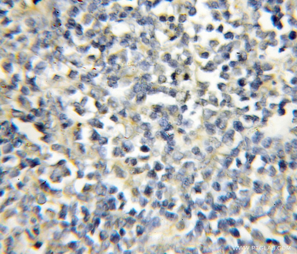 Immunohistochemistry (IHC) staining of human lymphoma tissue using RAG2 Polyclonal antibody (11825-1-AP)