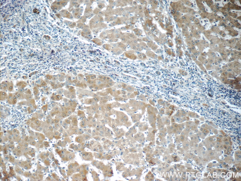 Immunohistochemistry (IHC) staining of human hepatocirrhosis tissue using MOK Polyclonal antibody (23926-1-AP)