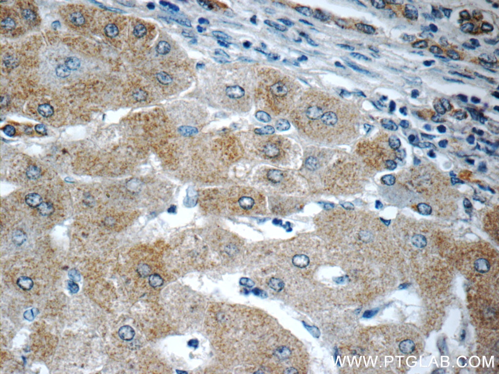 Immunohistochemistry (IHC) staining of human hepatocirrhosis tissue using MOK Polyclonal antibody (23926-1-AP)