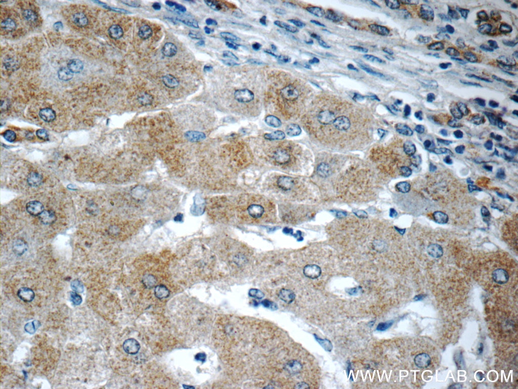 IHC staining of human hepatocirrhosis using 23926-1-AP