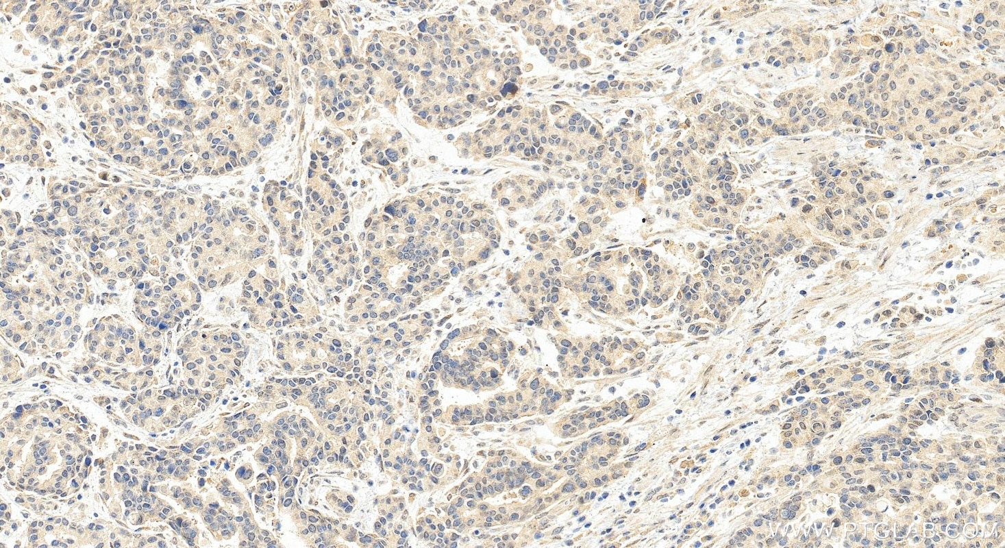 Immunohistochemistry (IHC) staining of human stomach cancer tissue using RAI1 Polyclonal antibody (17084-1-AP)
