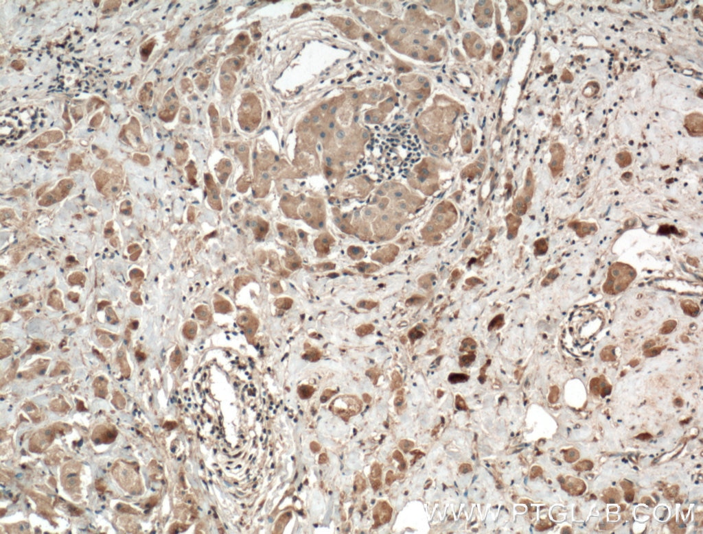 Immunohistochemistry (IHC) staining of human breast cancer tissue using RALA Polyclonal antibody (13629-1-AP)
