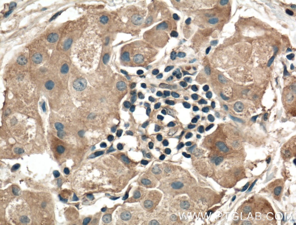 Immunohistochemistry (IHC) staining of human breast cancer tissue using RALA Polyclonal antibody (13629-1-AP)