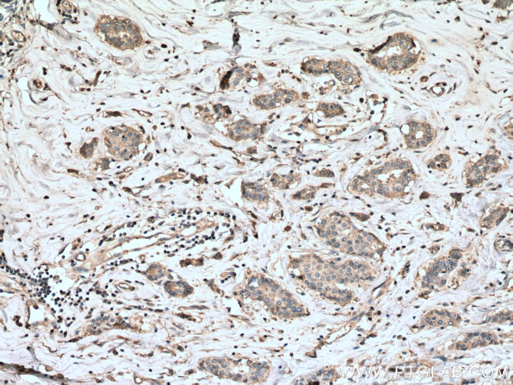 Immunohistochemistry (IHC) staining of human breast cancer tissue using RALA Monoclonal antibody (67093-1-Ig)