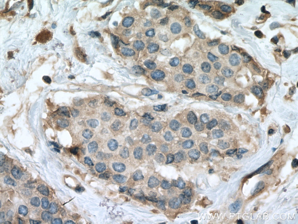 Immunohistochemistry (IHC) staining of human breast cancer tissue using RALA Monoclonal antibody (67093-1-Ig)