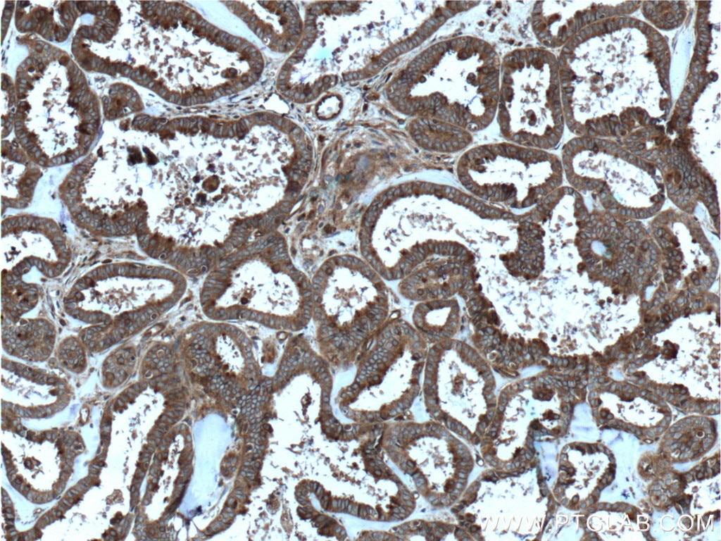 Immunohistochemistry (IHC) staining of human ovary tumor tissue using RALB Polyclonal antibody (12340-1-AP)