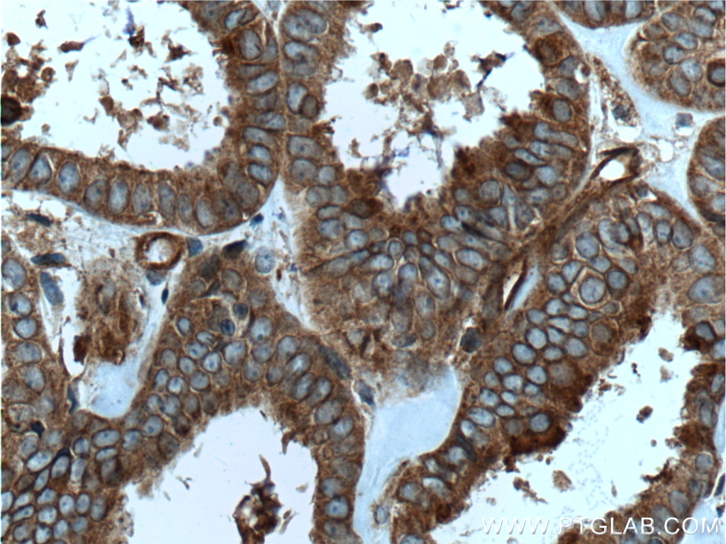 Immunohistochemistry (IHC) staining of human ovary tumor tissue using RALB Polyclonal antibody (12340-1-AP)