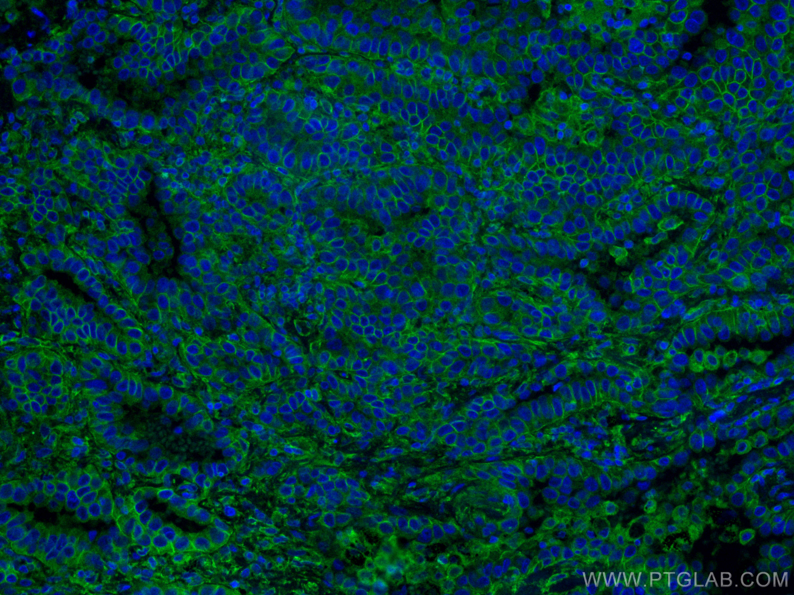 Immunofluorescence (IF) / fluorescent staining of human lung cancer tissue using RALB Monoclonal antibody (67094-1-Ig)