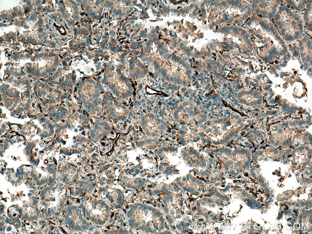 Immunohistochemistry (IHC) staining of human lung cancer tissue using RALB Monoclonal antibody (67094-1-Ig)