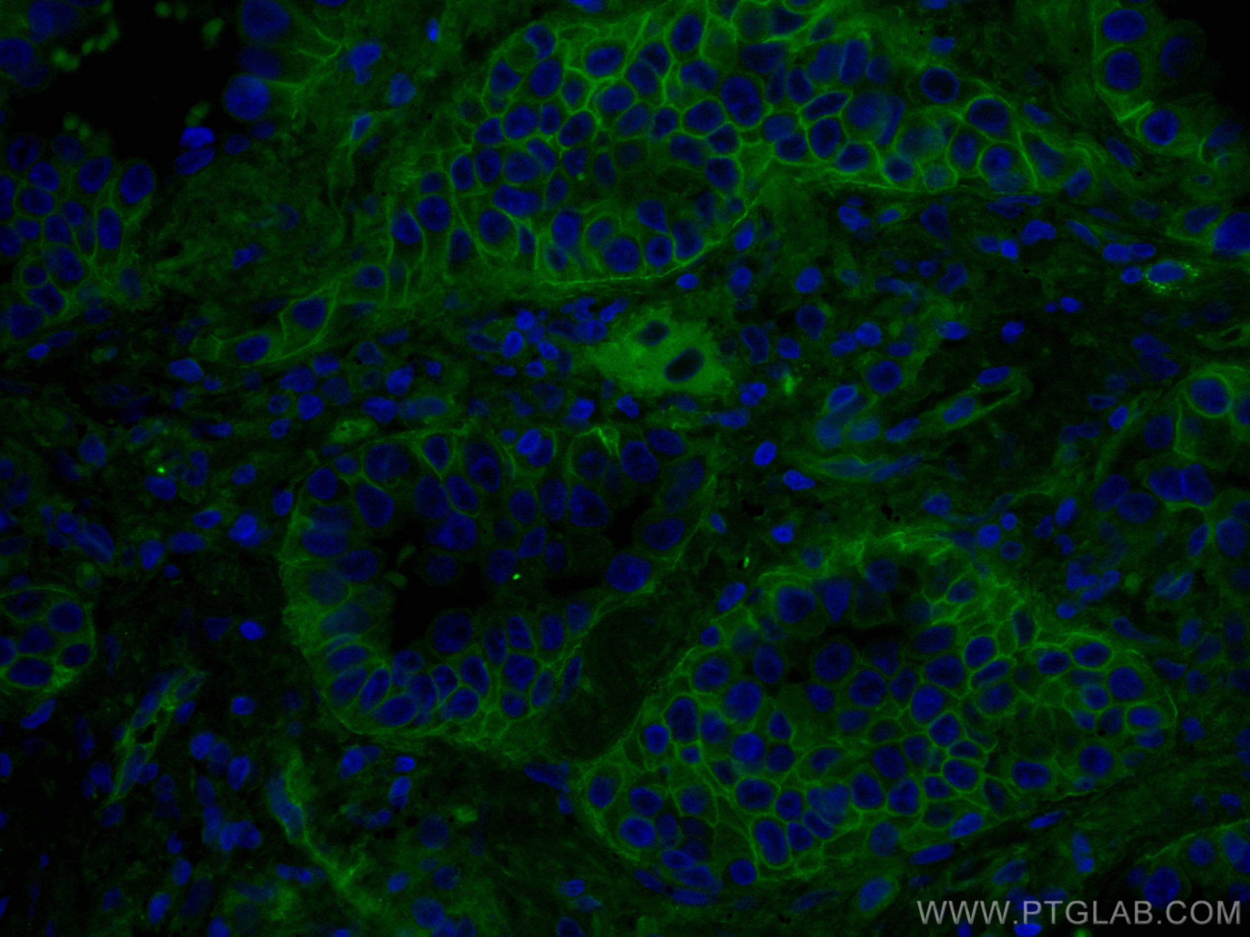 Immunofluorescence (IF) / fluorescent staining of human lung cancer tissue using CoraLite® Plus 488-conjugated RALB Monoclonal anti (CL488-67094)