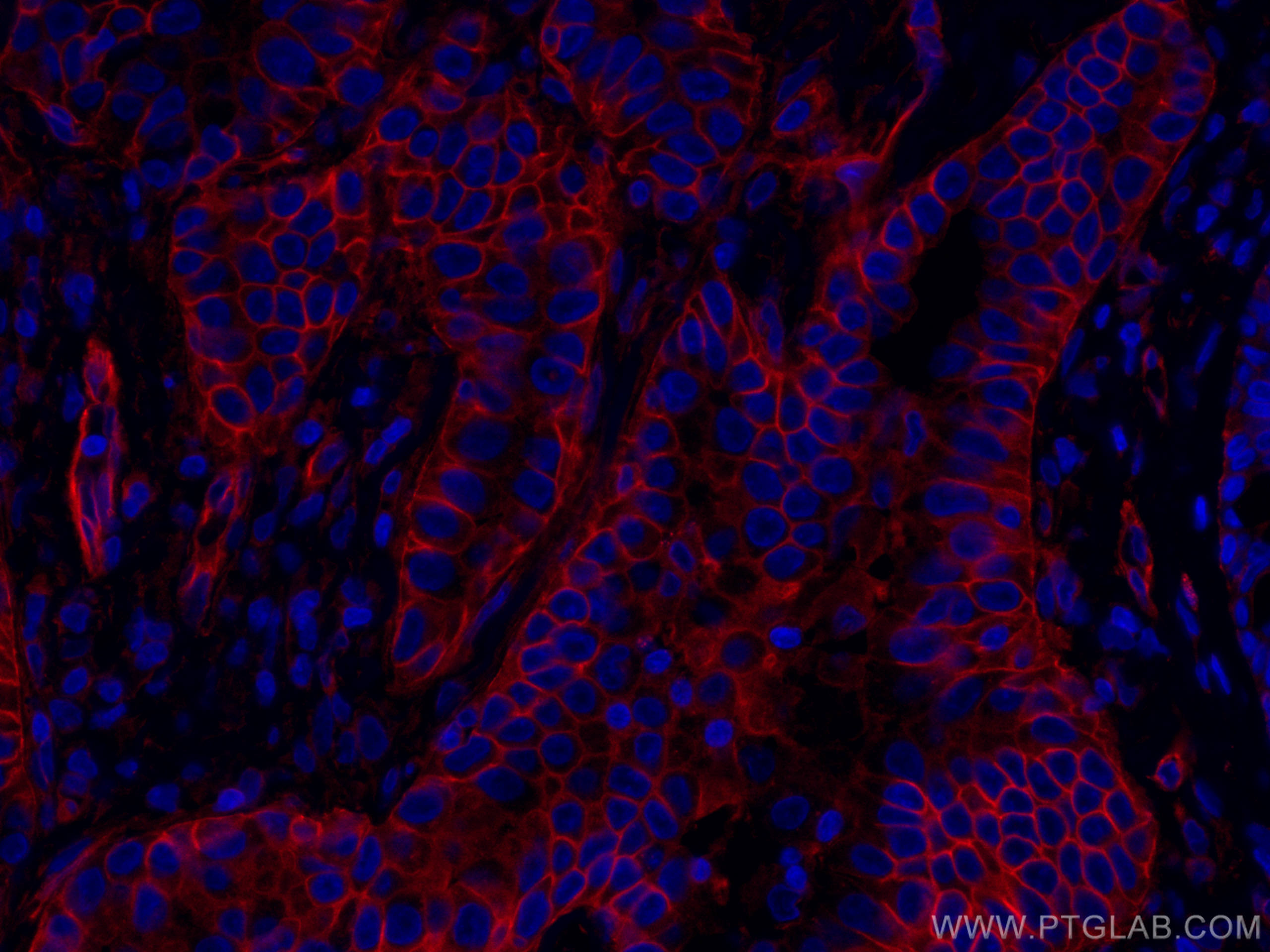 Immunofluorescence (IF) / fluorescent staining of human lung cancer tissue using CoraLite®594-conjugated RALB Monoclonal antibody (CL594-67094)