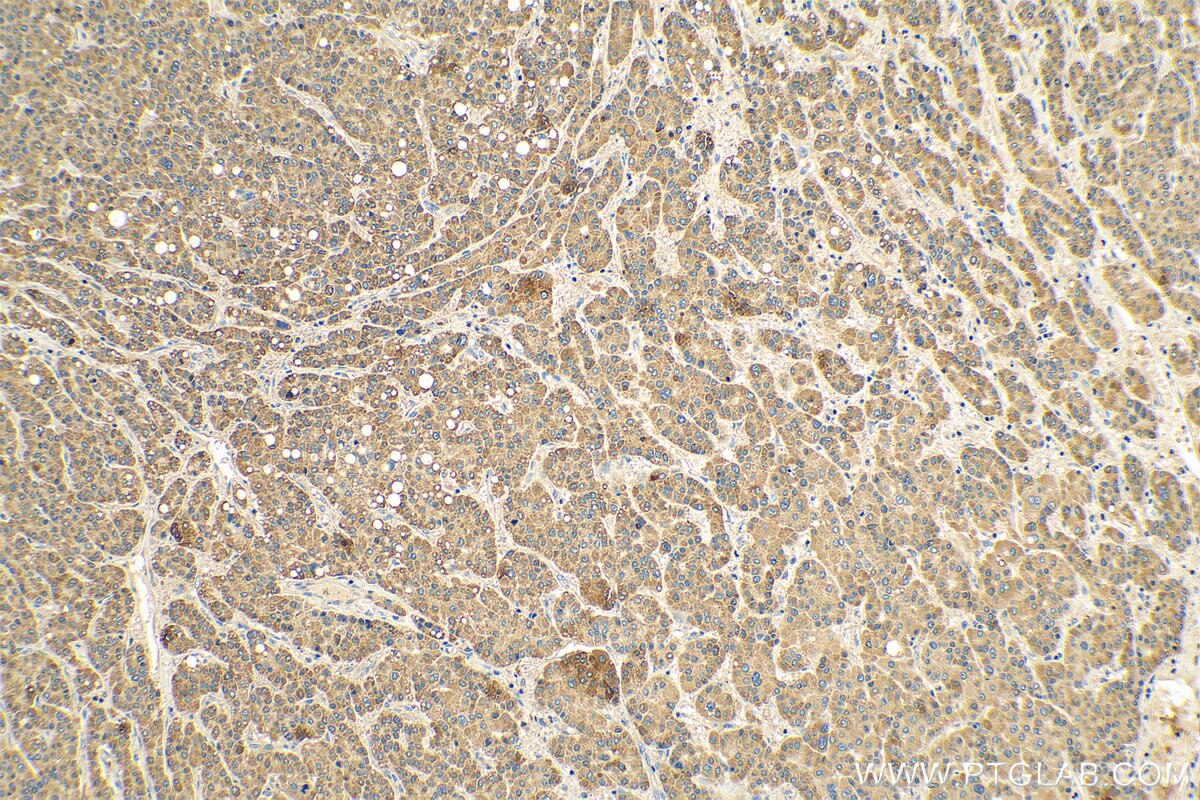 IHC staining of human liver cancer using 28330-1-AP